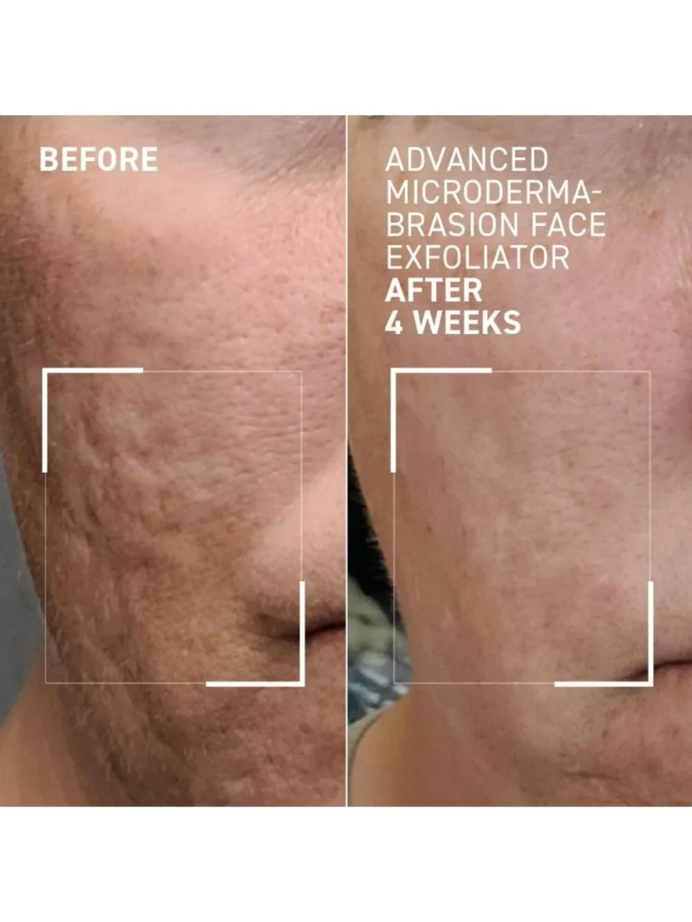 Travel Size Microdermabrasion Exfoliator - Refines Texture, Reduces Fine Lines
